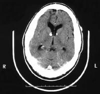 Tuberous Sclerosis Imaging