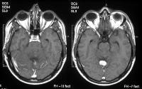von Hippel-Lindau syndrome. T1-weighted transaxial