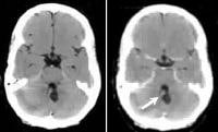 von Hippel-Lindau syndrome. Transaxial nonenhanced