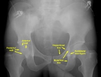 Radiografia ântero-posterior (AP) da pelve. Th ...