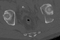 A tomografia computadorizada (TC) de uma posterior Colu ...