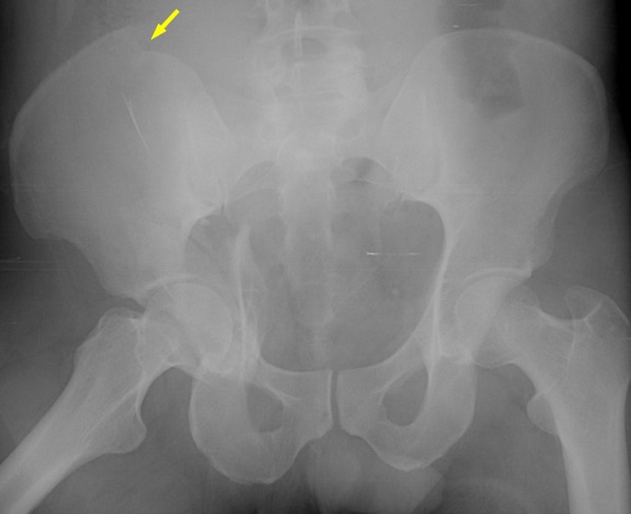 A nondisplaced fracture of the right inferior pubic ramus is subtle.