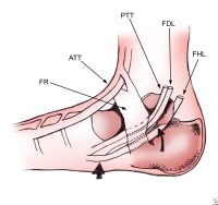 Foot Tendon Pain