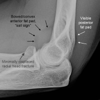 Imaging Of Elbow Fractures And Dislocations In Adults: Overview ...