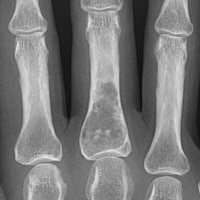 Femoral Enchondroma