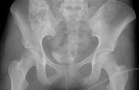 Pelvic Rami Fracture