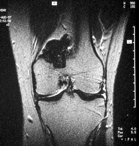 Synovitis Mri