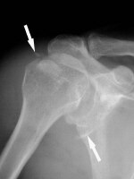 Ball+Catcher+X-ray causes the hill sachs defect on the posterosuperior humeral head