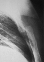radiografia lateral demonstra dislocat completa ...