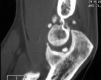 ct scan elbow