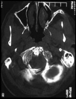 C1 Fracture