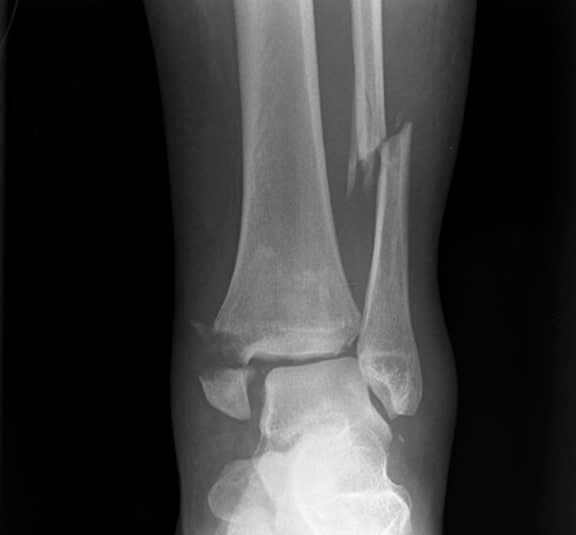 fibula fracture ankle