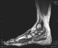 Flexor Hallucis Longus Tendon Injury Imaging