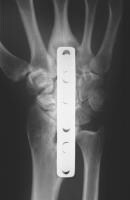 Bone Infarct Imaging