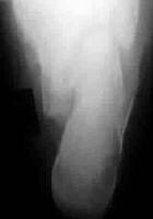 harris view calcaneus