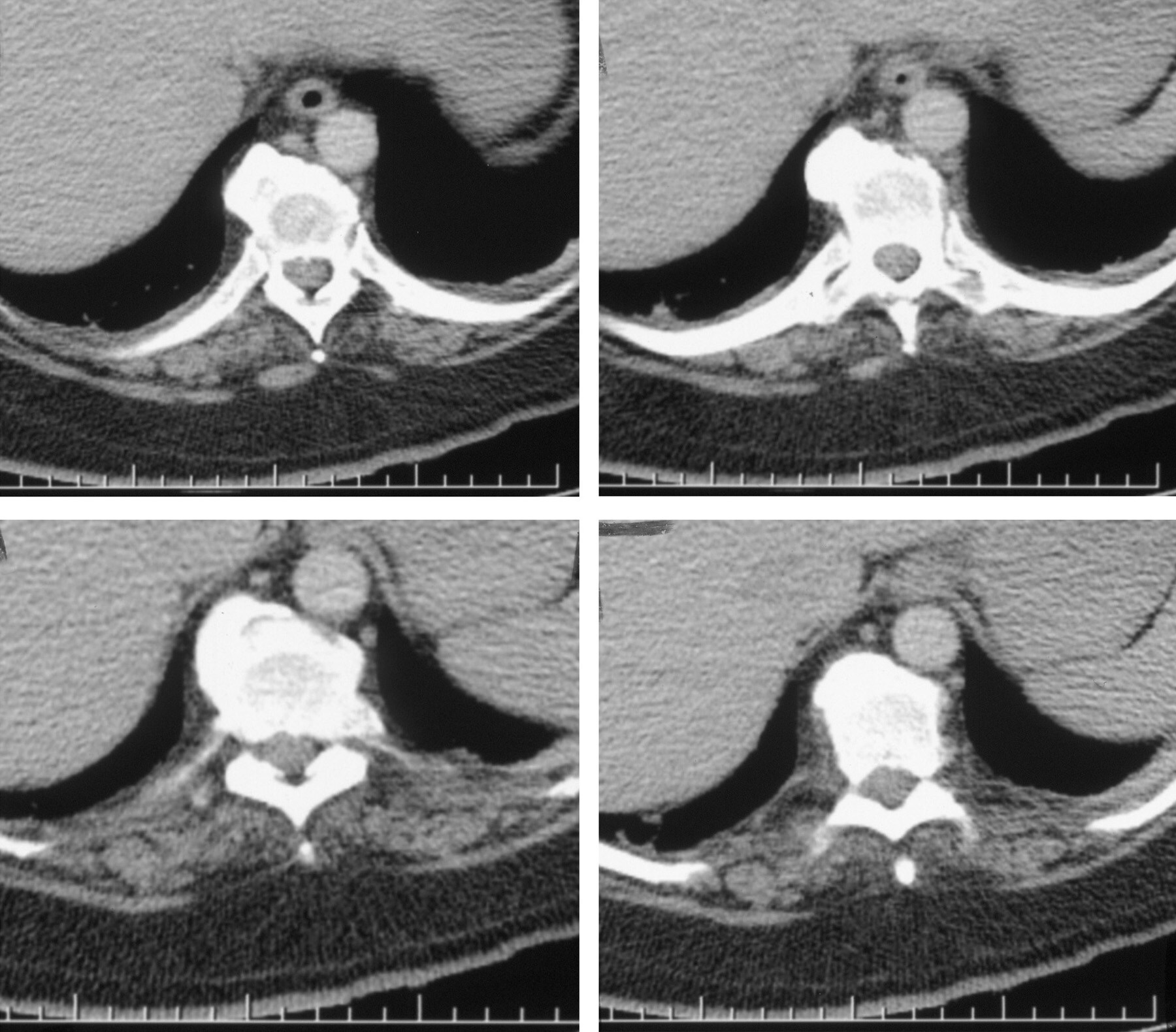 hyperostosis diffuse idiopathic skeletal complications hyperostosis diffuse idiopathic skeletal complications