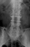 Radiograph of the lumbosacral spine (anteroposteri