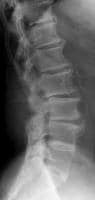 Radiograph of the lumbosacral spine (lateral view)