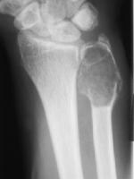 Femur Tumor
