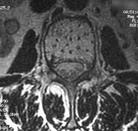 Bone Hemangioma Imaging