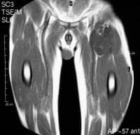 mri groin