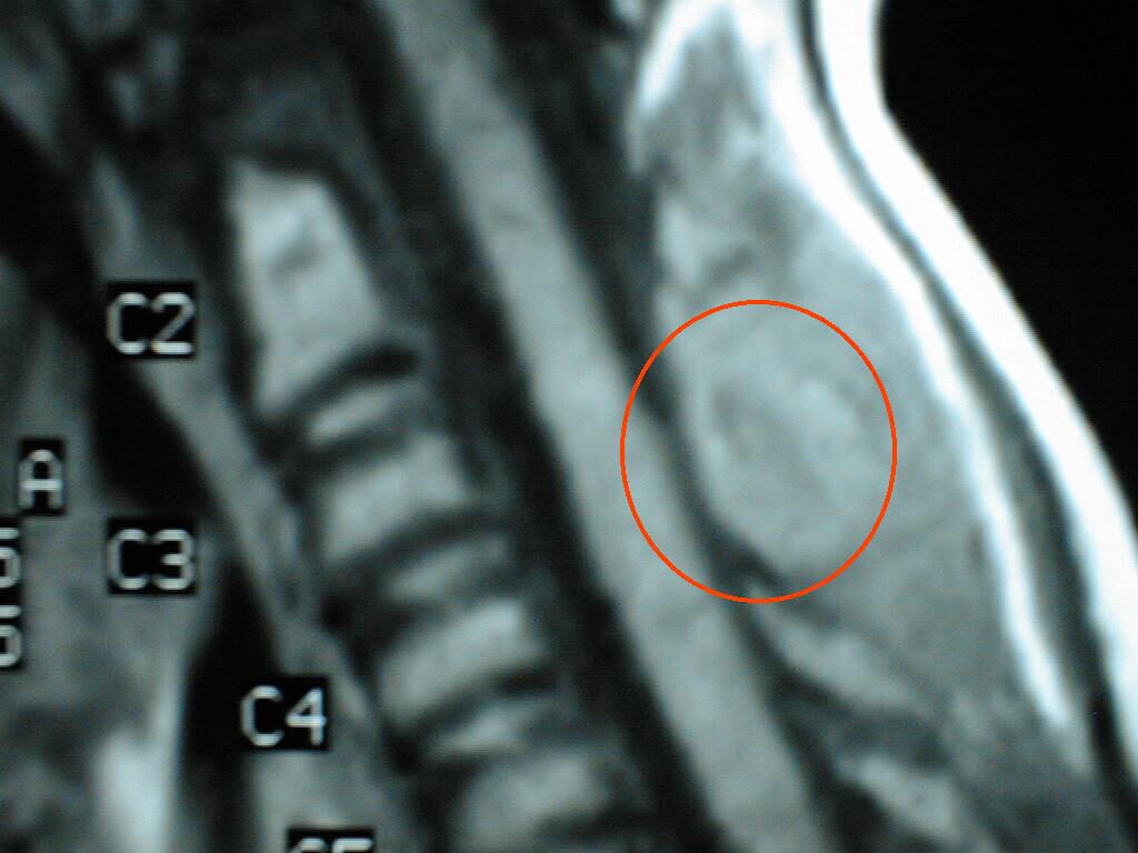 Cancer Signs And Symptoms Ppt