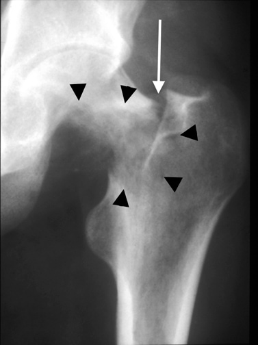 femoral neck fracture, Femoral Neck Stress Fracture Mri. femoral neck fracture,