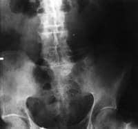 Anteroposterior radiograph of the abdomen shows f...