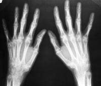 Posteroanterior radiograph of the hands shows wri...