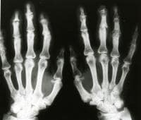 Anteroposterior radiograph of the hands shows sub...