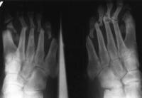 Anteroposterior radiograph of the feet shows arth...