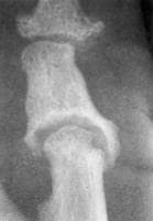 Anteroposterior radiograph of the thumb shows art...