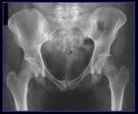 Anteroposterior radiograph of the pelvis in a mal...