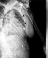 This detailed oblique radiograph shows 2 rib fractures (arrows) that are not depicted on anteroposterior (AP) chest radiographs.