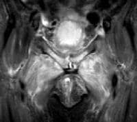 Coronal curta-tau inversão recuperação RM do p. ..