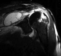 Coronal T2-weighted MRI gordura saturada do shou ...