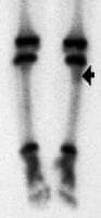 A nuclear medicine bone scan reveals mild uptake o