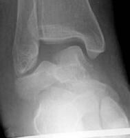 Talar body fracture, anteroposterior radiograph. ...