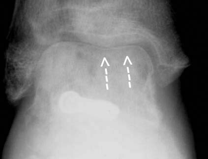 Partial Hawkins sign,  anteroposterior radiograph....