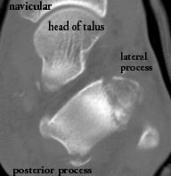 Fractures of the lateral and  posterior processes ...