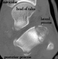 Fractures of the lateral and posterior processes ...