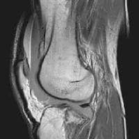 Tibial plateau fractures. MRI of the knee in a pat