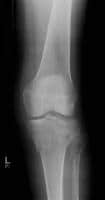 Tibial plateau fractures. Radiograph of the knee r