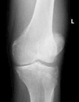 Tibial plateau fractures. Oblique radiograph of th