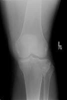 Tibial plateau fractures. A different patient illu