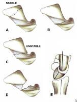 Scaphoid Fracture Imaging: Overview, Radiography, Computed Tomography