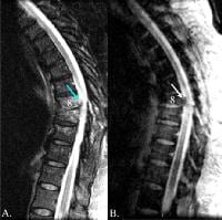 Thoracic Spine Injuries