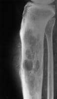 Lymphoma Knee