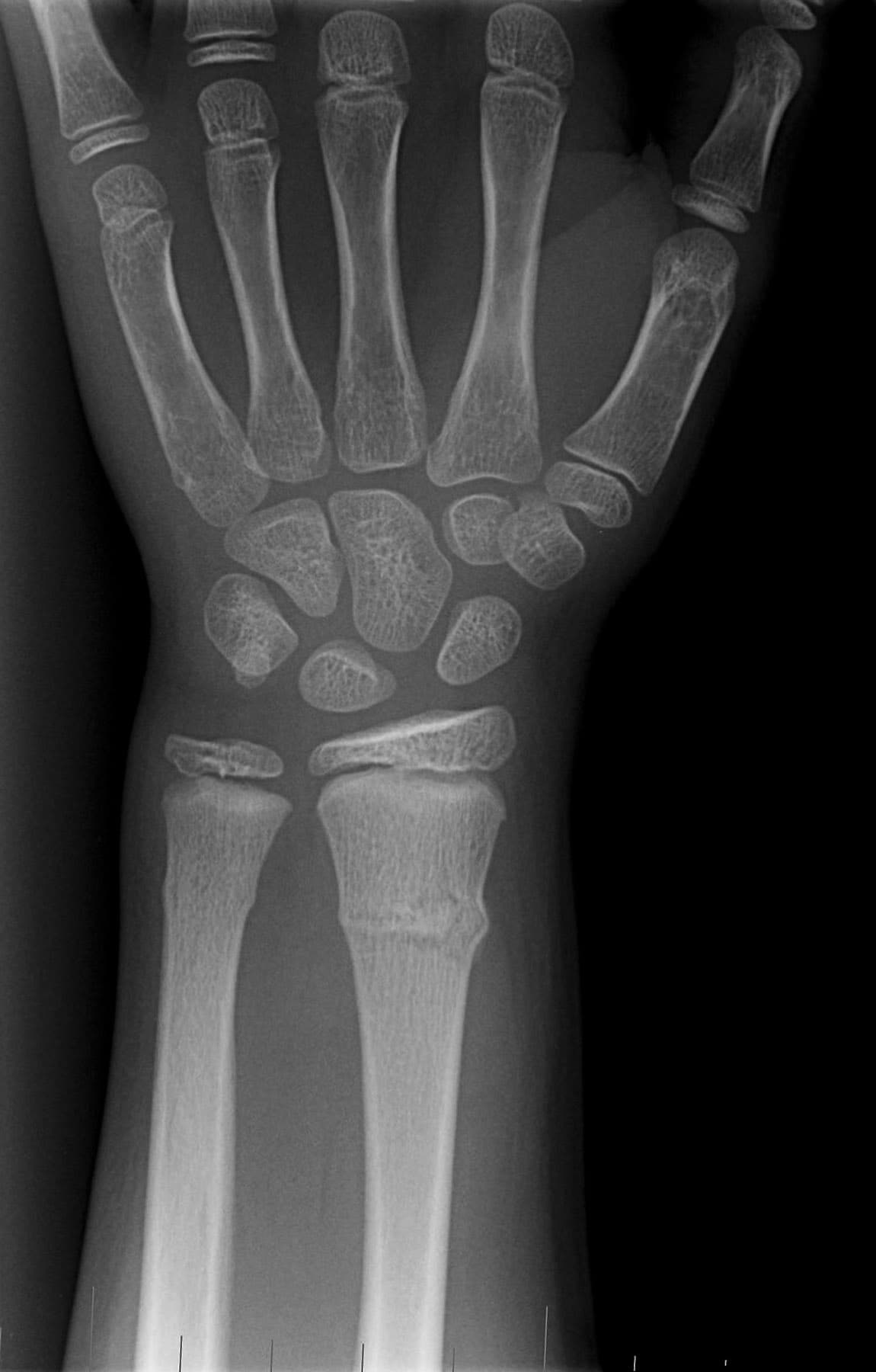 buckle fracture ulna