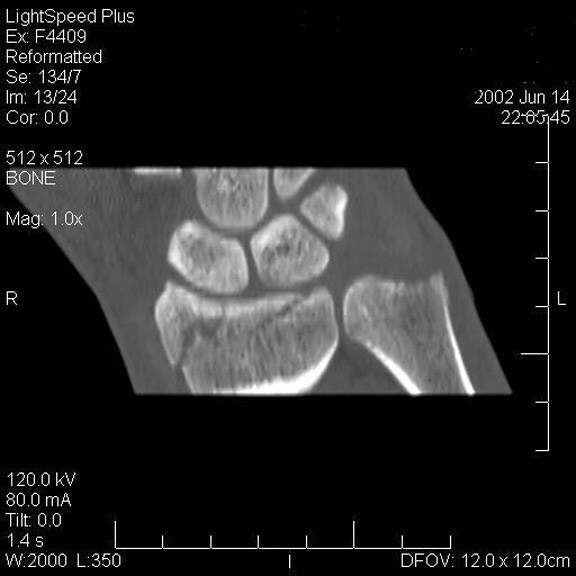 a distal radial fracture.